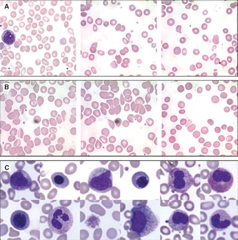 tear drop test|Significance of teardrop cells in peripheral blood .